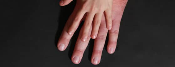 Acromégalie_Manifestations cliniques