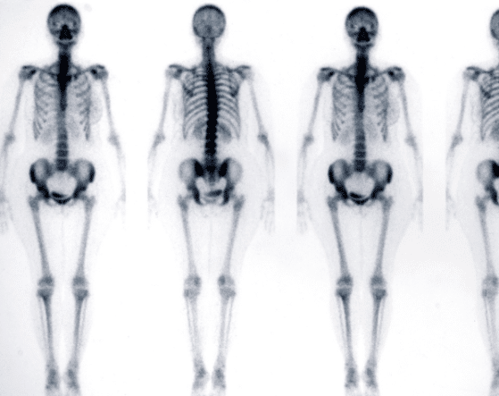 amylose - scintigraphie