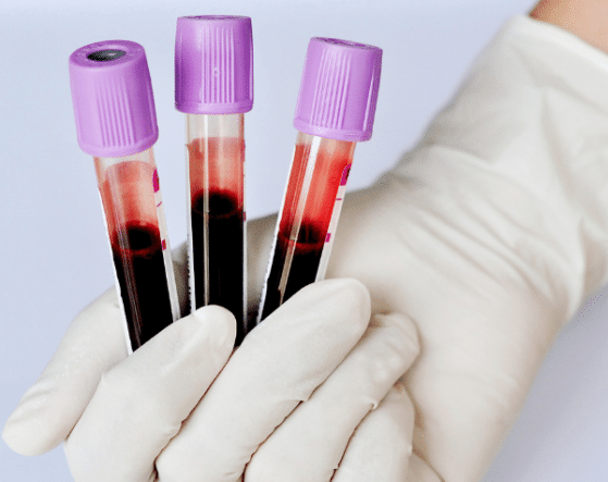 diagnostic de l’hyperoxalurie primitive