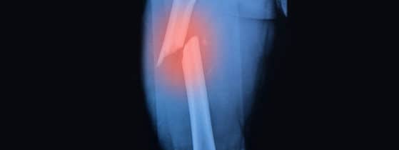 Ostéogenèse imparfaite - maladies génétiques