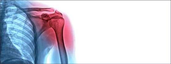 Ostéogenèse imparfaite - symptômes
