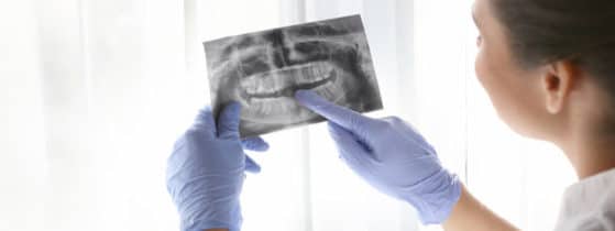 Ostéogenèse imparfaite - comorbidités extra-osseuses