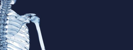 Ostéogenèse imparfaite