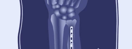 Ostéogenèse imparfaite - traitement chirurgical
