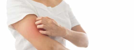 Lymphomes T cutanés - Plaques rouges