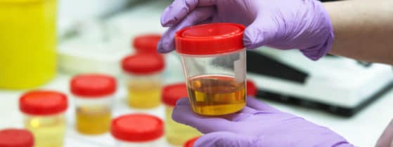 Syndrome Hémolytique et Urémique atypique - Atteinte rénale