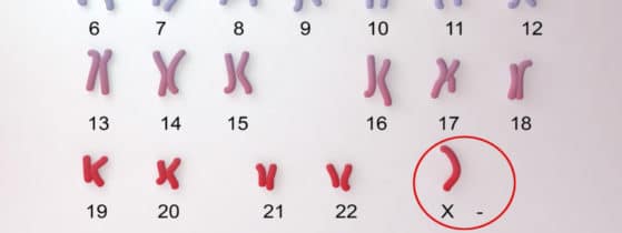 Syndrome de Turner – Caryotype