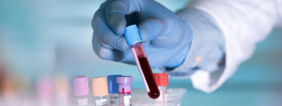 SMA infantile - Diagnostic génétique