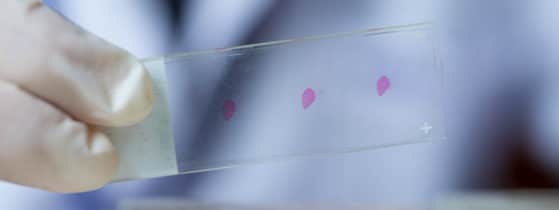 Maladie de Wilson - Diagnostic