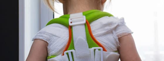 SMA infantile - Prise en charge orthopédique