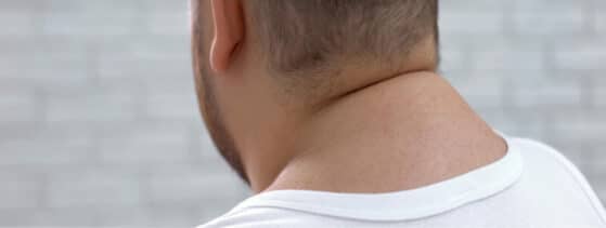 Lipodystrophies - Définition