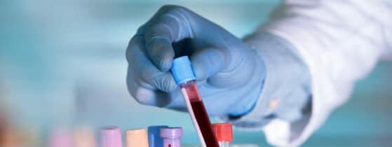 Lipodystrophies - Diagnostic