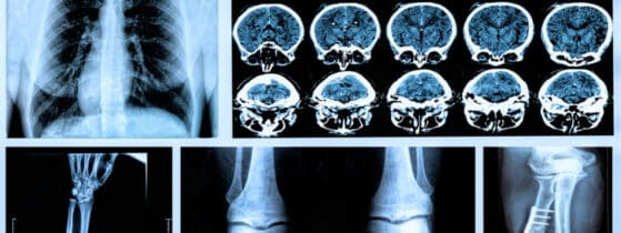 TIO - prise en charge