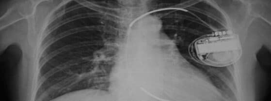 Mort subite sujet jeune - Défibrillateur implantable