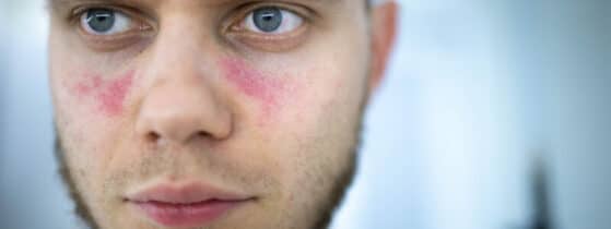 Diagnostic du lupus systémique