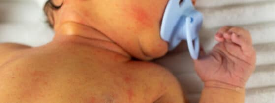 DAAT - Jaunisse bébé