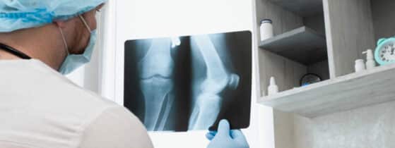 Définition de l’achondroplasie