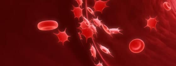 Définition du Purpura Thrombopénique Immunologique (PTI)