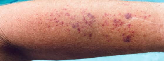 Les symptômes du Purpura Thrombopénique Immunologique (PTI)