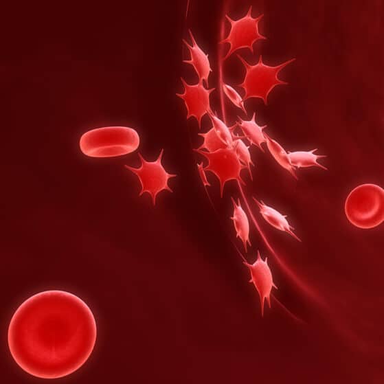 Le Purpura Thrombopénique Immunologique (PTI)