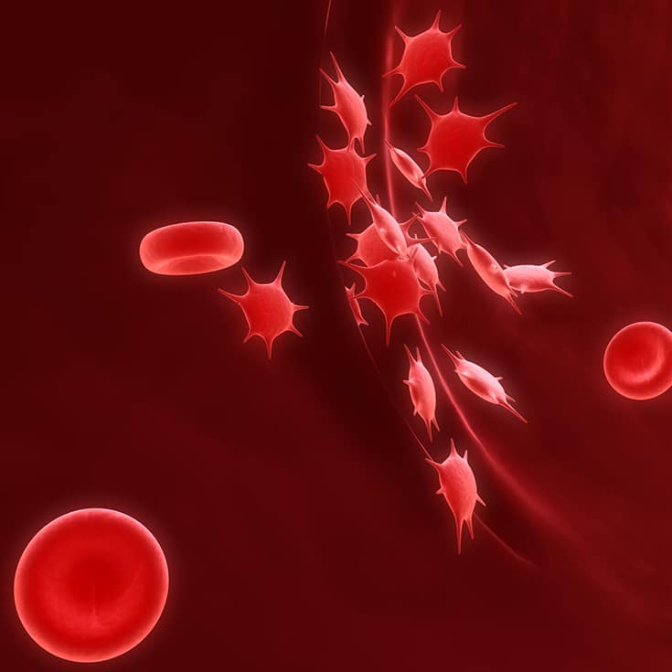 Le Purpura Thrombopénique Immunologique (PTI)