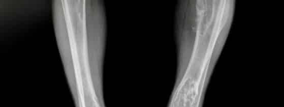 Définition de la Dysplasie Fibreuse des Os (DFO)