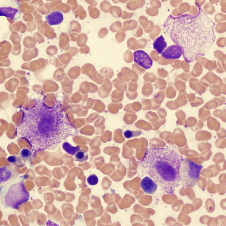 Mastocytoses
