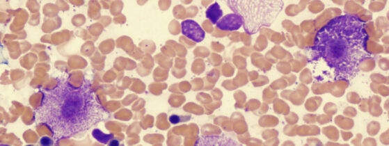 Les points clés – Mastocytoses