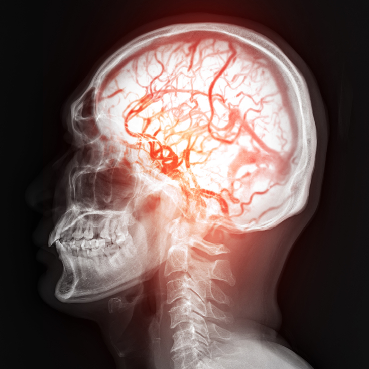 Maladie de Moyamoya[